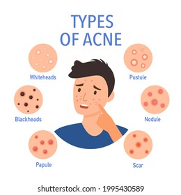 Types of acne on the skin infographic in flat design. Worry man on pimple skin problem.