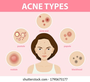 Types Acne On Skin Pimples Illustration Stock Vector (Royalty Free ...