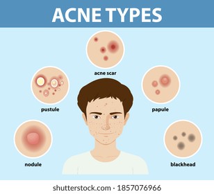 Types Acne On Skin Pimples Illustration Stock Vector (Royalty Free ...