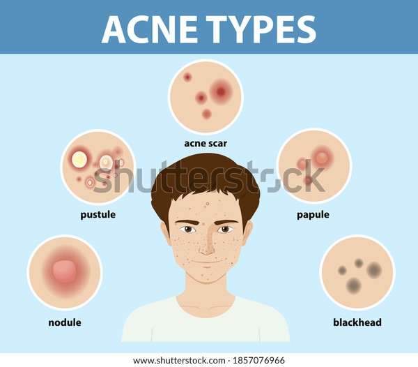 Types Acne On Skin Pimples Illustration Stock Vector (Royalty Free ...