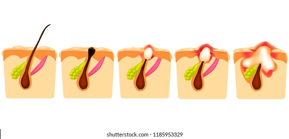 Types of acne. Open comedones, closed comedones, inflammatory acne, cystic acne. The structure of the skin. Infographics. Vector illustration on isolated background