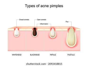 3,251 Papules Images, Stock Photos & Vectors | Shutterstock