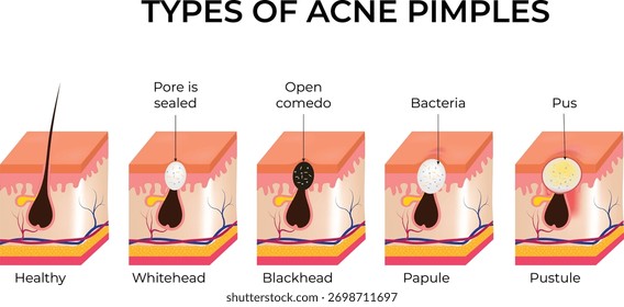 Tipos de espinhas de acne explicado Um guia visual para as condições da pele