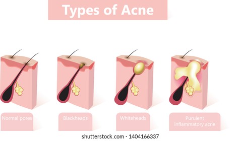 Types Acne Pimples Healthy Skin Whiteheads Stock Vector (Royalty Free ...