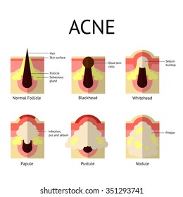 Types of acne pimples. Healthy skin, Whiteheads and Blackheads, Papules and Pustules in flat style.