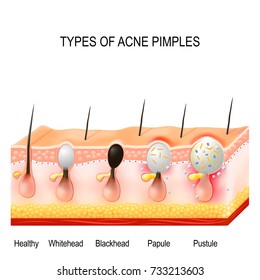 Types Of Acne Chart