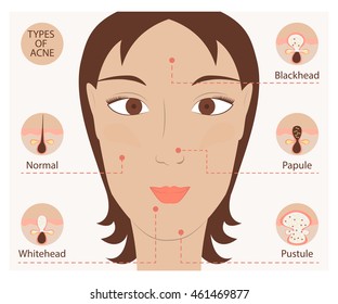 Types of acne pimples human skin poster. Facial treatments infographic.
Modern flat design. Sebum in clogged pore, growth bacteria, redness, inflammation. Womens Beauty care. Vector illustration eps10