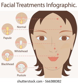 Types of acne pimples human skin poster. Facial treatments infographic. Modern flat design. Sebum in clogged pore, growth bacteria, redness, inflammation. Womens Beauty care. Vector illustration eps10