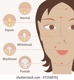 Types of acne pimples human skin poster. Facial treatments infographic. Modern flat design. Sebum in clogged pore, growth bacteria, redness, inflammation. Womens Beauty care. Vector illustration eps10