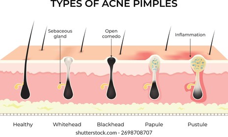 Tipos de espinhas de acne diagrama de seção transversal da pele