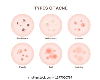 Types of acne, pimples, skin pores, blackhead, whitehead, scar, comedone. Vector icons of skin acne pimples, cosmetology and skincare problems.