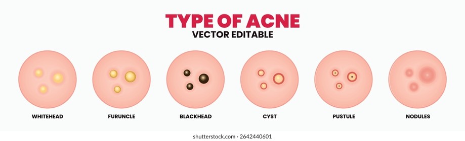 Tipos de acne, espinhas, poros de pele, cabeça negra, cabeça branca, cicatriz, comedão. Ícones vetoriais de espinhas de acne da pele, cosmetologia e problemas de cuidados da pele.
