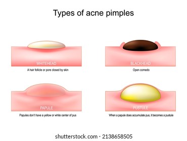 Types of acne pimples.  Vector illustration