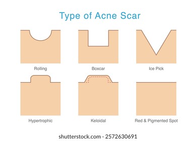 Types of acne scar on facial skin layer. Rolling, Boxed, Icepick, keloid, and hypertrophic scars isolated white background. Vector Medical diagram about skin problem from acne.