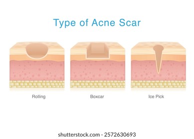 Types of acne scar on facial skin layer. Rolling, Boxed and Icepick scars isolated white background. 3D vector Medical diagram about skin problem from acne.