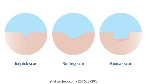 Types of acne scar vector icon set isolated on white background. Cross section of icepick scar, rolling scar and boxcar scar with skin surface. Skin care and beauty concept illustration.