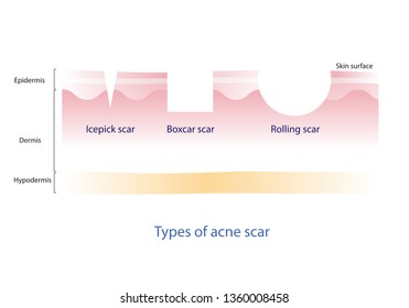 Types Of Acne Scar Vector On White Background.