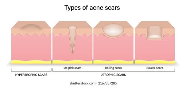 Types of acne scars. Facial skin problems. Hypertrophic scars and Atrophic scars. Vector for advertising about beauty and medical treatment.