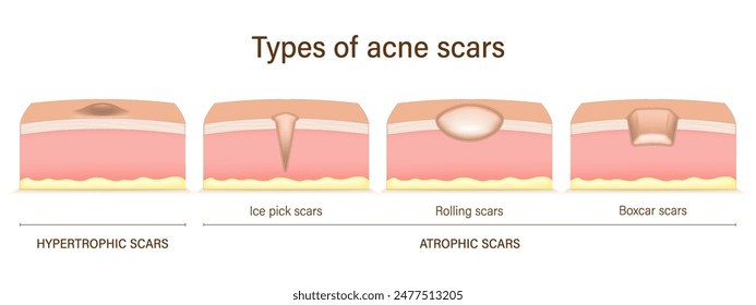 Types of acne scars. Facial skin problems. Hypertrophic scars and Atrophic scars. Vector for advertising about beauty and medical treatment. Acne scar analysis.