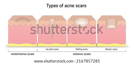 Types of acne scars. Facial skin problems. Hypertrophic scars and Atrophic scars. Vector for advertising about beauty and medical treatment. Imagine de stoc © 