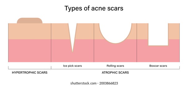 Vector de cicatrices de acné.  Análisis de la cicatriz acné