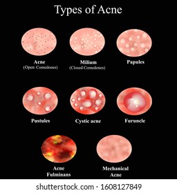 Types of Acne Skin inflammation. Pimples, boils, whitehead, closed comedones, papules, pustules, cystic acne. Infographics. Vector illustration on a black background.