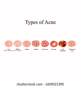 Types of Acne Skin inflammation. Pimples, boils, whitehead, closed comedones, papules, pustules, cystic acne. Infographics. Vector illustration on isolated background.