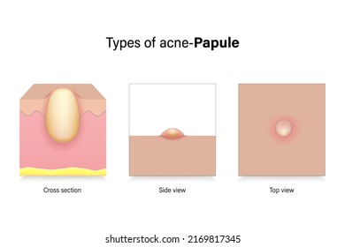 Types Of Acne. Skin Problems. Papule In Cross Section, Side View And Top View. Vector For Advertising About Beauty And Medical Treatment.