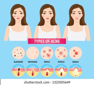 Types Acne Skin Problems Vector Illustration Stock Vector (Royalty Free ...