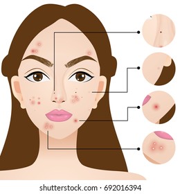 types of acne , skin problems vector illustration