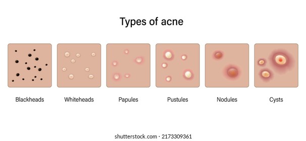 Types of acne skin vector. Blackheads, Whiteheads, Papules, Pustules, Nodules and Cysts. 