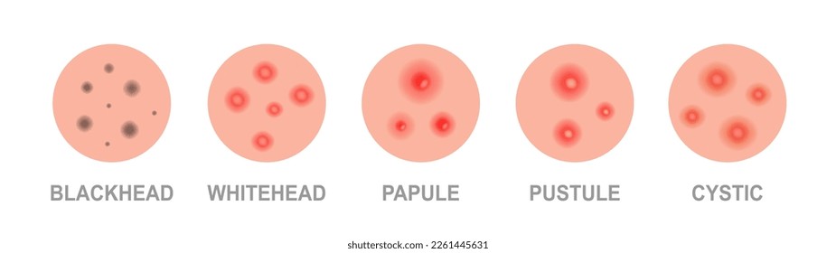 Types of acne. Skincare problems and inflammation. Acne skin types - blackheads, whiteheads, papules, pustules, cystic and nodular.