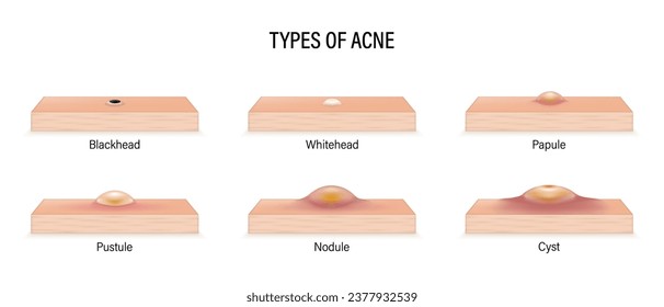 Types of acne. Skincare problems and inflammation. Blackheads, Whiteheads, Papules, Pustules, Nodules and Cysts. Vector for advertising about beauty and medical treatment.