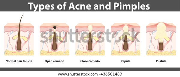 Types Acne Structure Pimple Detailed Drawing Stock Vector (Royalty Free ...