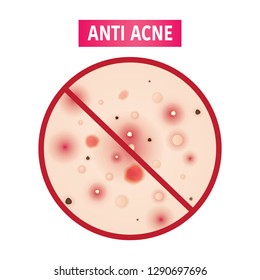 Types Acne Vector Illustration Stock Vector Royalty Free 1290697696 Types Acne Vector Illustration Stock Vector Royalty Free 1290697696