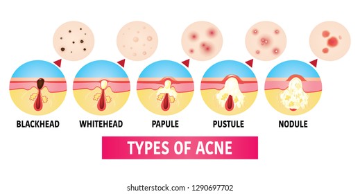 Types Acne Vector Illustration Stock Vector (Royalty Free) 1290697702 ...