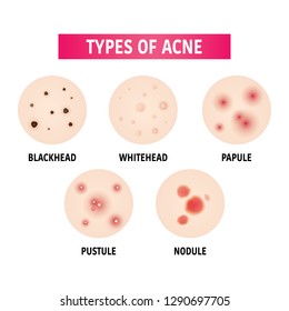 types of acne vector illustration