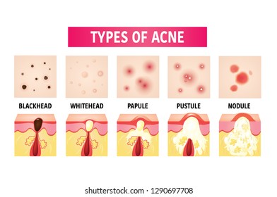 Types Of Acne Vector Illustration