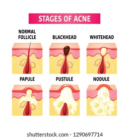 types of acne vector illustration