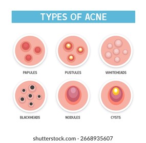 Tipos de acne. Ilustração vetorial isolada sobre fundo branco.