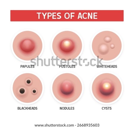 Types of acne. Vector illustration isolated on white background.