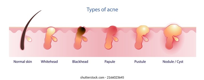 Types Of Acne Vector Isolated On White Background. Formation Of Normal Skin, Acne, Pimple, Comdone, Non Inflammatory Acne, Whitehead, Blackhead, Inflammatory Acne, Papule, Pustule, Nodule And Cyst.