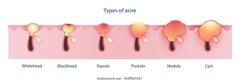 Types of acne vector on white background. Formation of noninflammatory acne, whitehead, blackhead, inflammatory acne, papule, pustule, nodule and cyst. Skin care and beauty concept illustration.