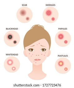 Types of acne and woman face illustration. whitehead,black head, papules, and pustules. Beauty skin care concept