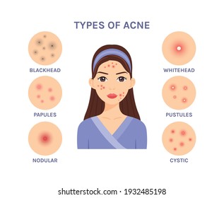 Types of acne,pimples. Isolated cute cartoon brunette girl in a bathrobe, with problem skin, close-up, on a white background. Color cartoon flat illustration. White background. Vector.