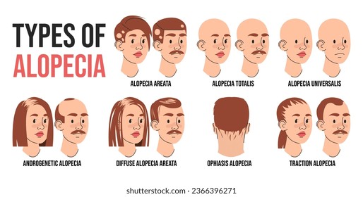 Types of alopecia infographic vector isolated. Illustration of people suffering from hair loss. Alopecia areata, totalis and universalis. Androgenetic and traction alopecia.