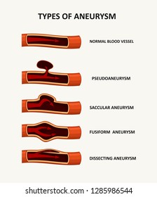 Types Of Aneurysm 