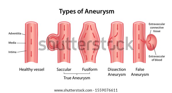 Types of aneurysm: True Aneurysm (Saccular,\
Fusiform), False Aneurysm and Dissection Aneurysm. Longitudinal\
section of blood vessels indicating blood flow. Vector illustration\
in flat style