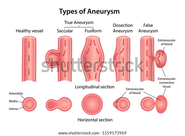 Types of aneurysm: True Aneurysm (Saccular, Fusiform),\
False and Dissection Aneurysms. Longitudinal and horizontal\
sections of blood vessels. Blood flow direction indicated. Vector\
illustration 