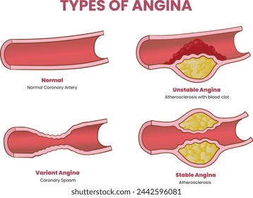 types of angina illustration - vector